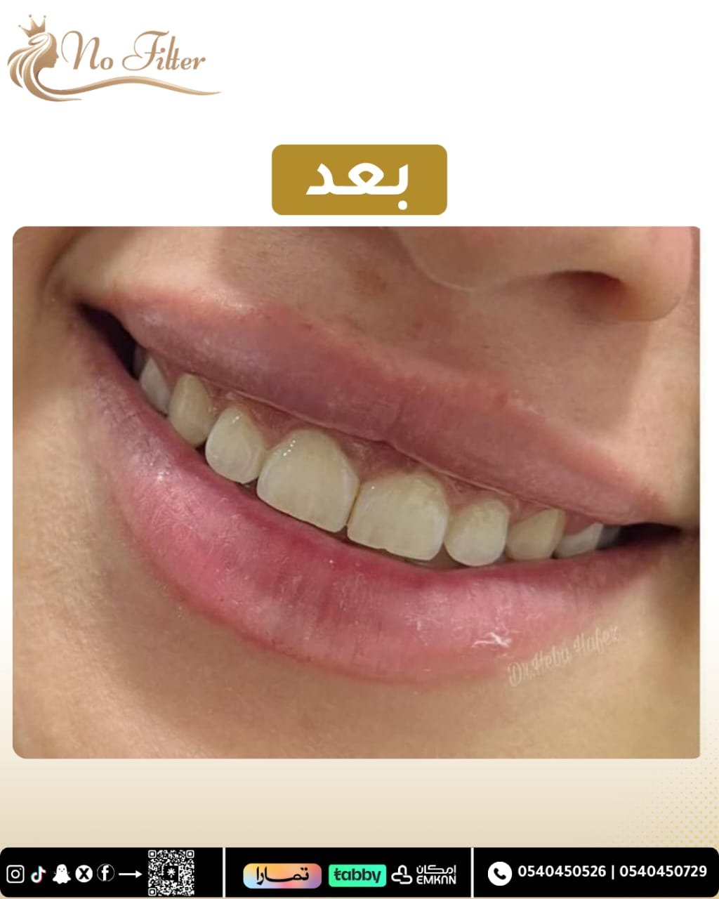 Botox For Gummy Smile